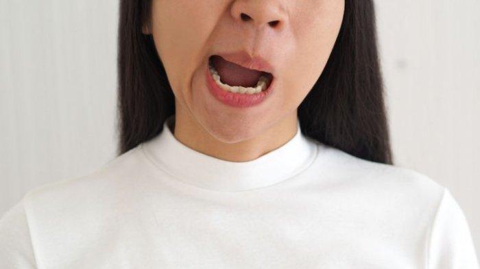 ilustrasi penyakit bells palsy