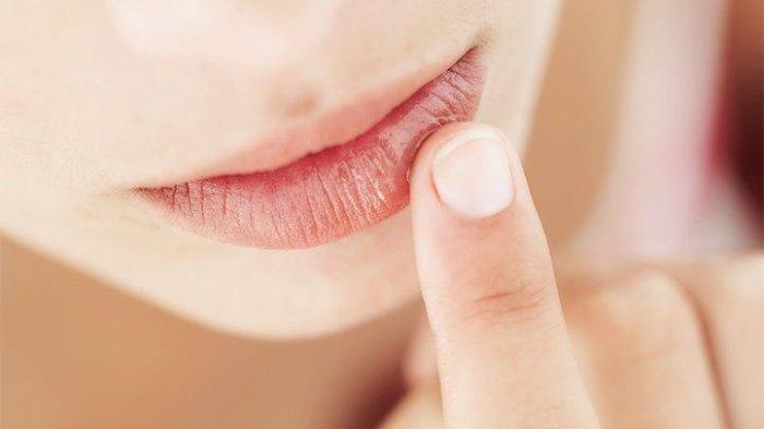 ilustrasi bibir kering dan pecah-pecah saat puasa, berikut cara mengatasinya
