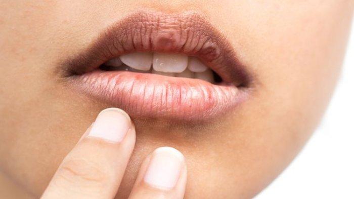 ilustrasi seseorang yang mengalami masalah mulut dan bibir kering saat menjalankan puasa, berikut tips mengatasinya