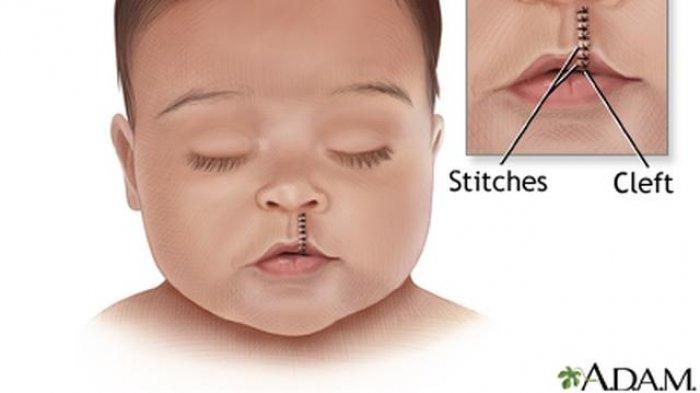 ilustrasi seorang anak yang mengalami bibir sumbing