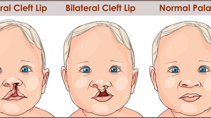 ilustrasi bibir sumbing