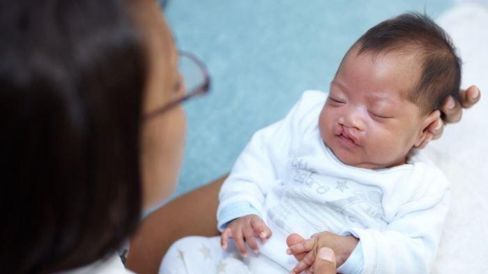 ilustrasi bayi yang mengalami bibir sumbing