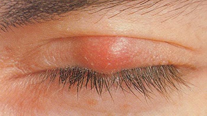 ilustrasi seseorang yang mengalami bintitan, berikut kondisi bintitan yang harus dilakukan operasi