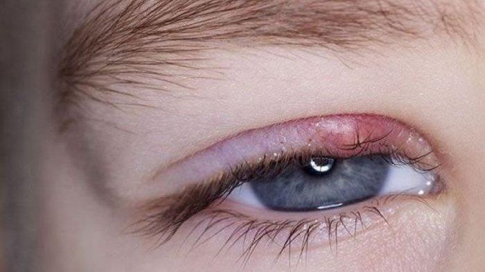 ilustrasi seseorang yang mengalami bintitan, berikut kondisi bintitan yang harus dilakukan operasi