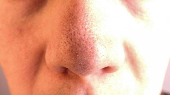 ilustrasi blackhead atau komedo hitam