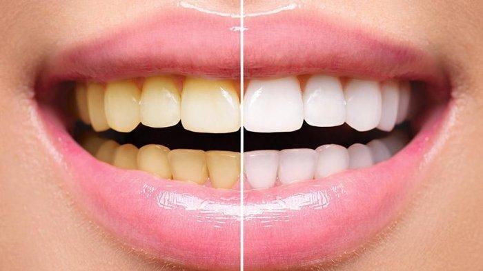 ilustrasi sebelum dan sesudah melakukan bleaching gigi