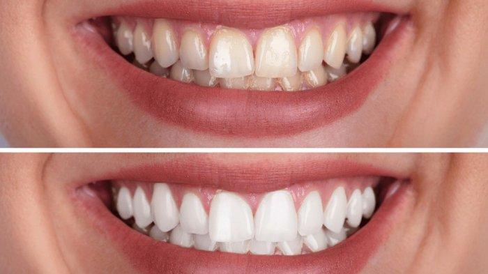 ilustrasi perbandingan gigi sebelum dan sesudah bleaching