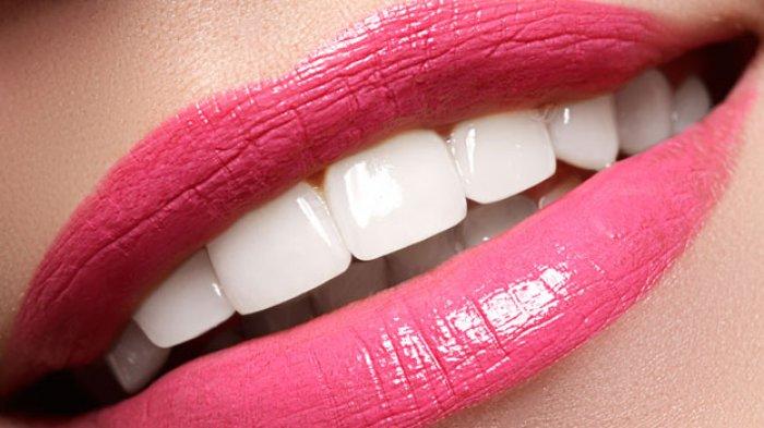 ilustrasi gigi yang telah dibleaching