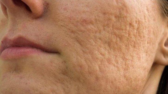 ilustrasi acne scars atau bopeng pada wajah