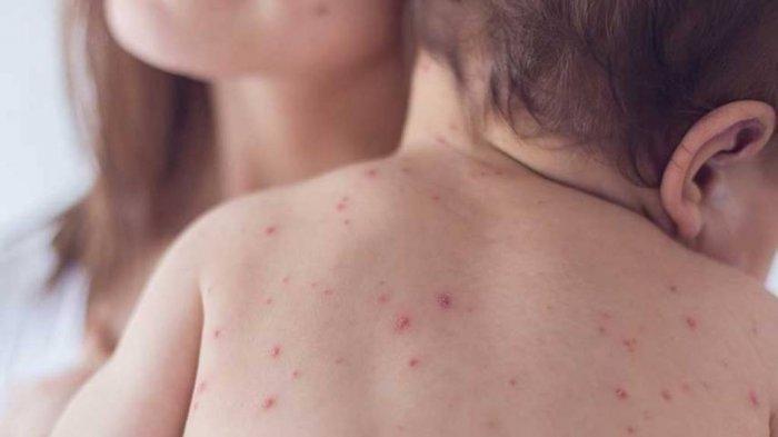 ilustrasi anak yang mengalami cacar air, berikut tips untuk menyembuhkannya