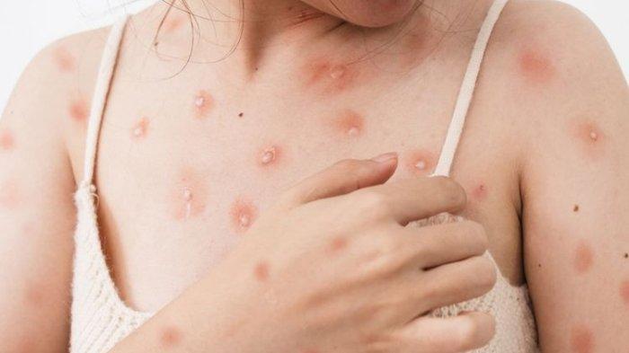 Cacar Air dan Herpes Penyakit yang Sama atau Beda? Begini Jawaban Dokter  Spesialis Kulit dan Kelamin - TribunHealth.com