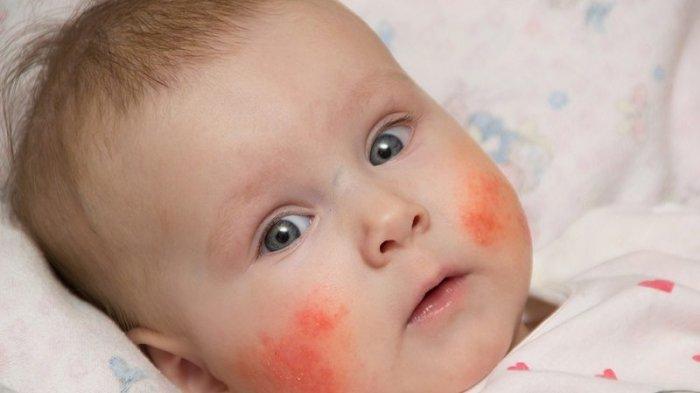 Ilustrasi bayi yang mengalami iritasi kulit, berikut ini cara mencegah dan mengatasi iritasi pada kulit bayi