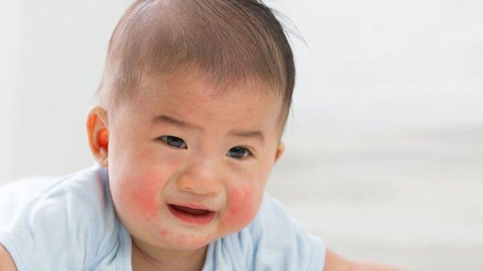 ilustrasi bayi yang mengalami iritasi kulit, berikut ini pertolongan pertama yang bisa dilakukan oleh orang tu