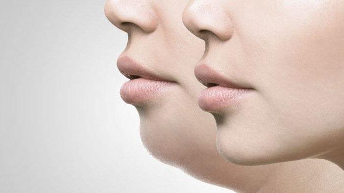 ilustrasi seseorang yang mengalami double chin, berikut ini penyebab terjadinya double chin