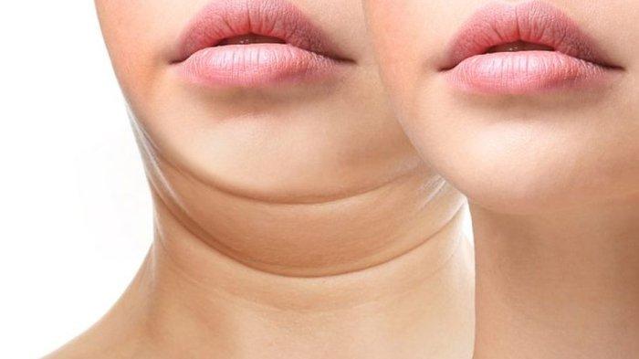 ilustrasi seseorang yang memiliki double chin