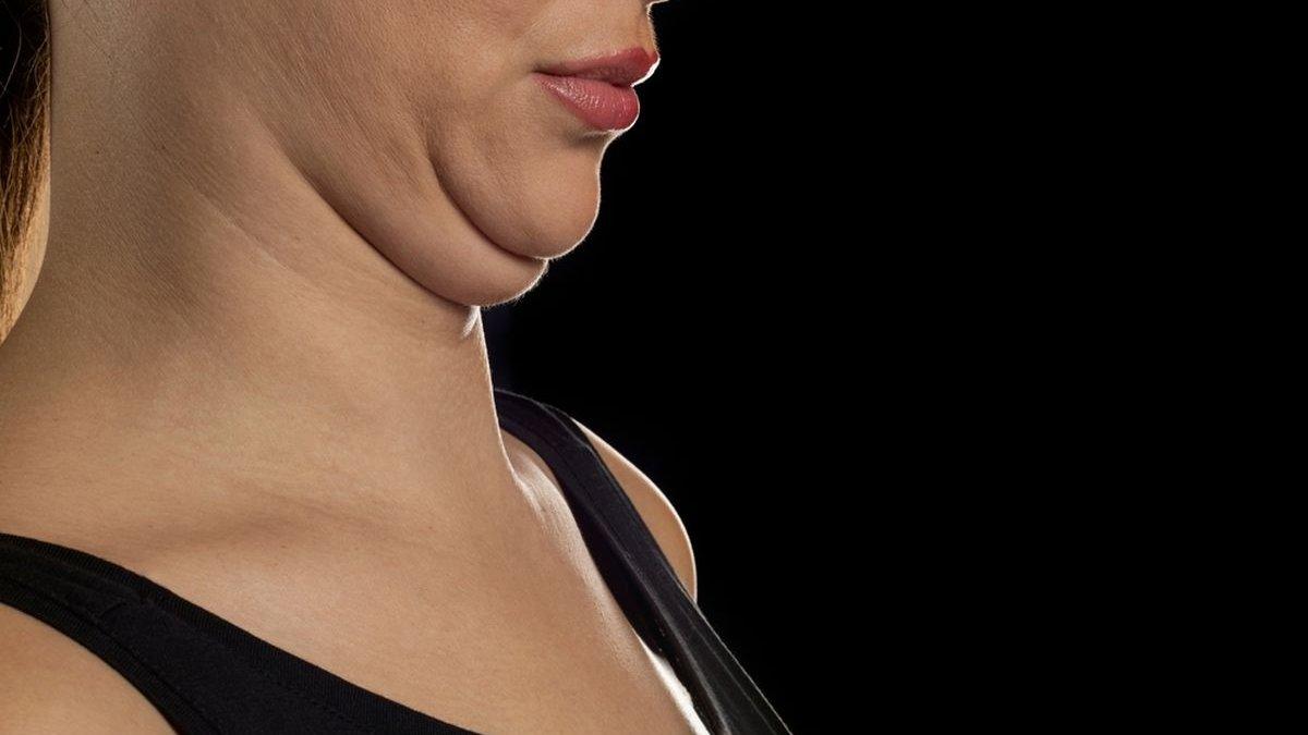 ilustrasi seseorang yang memiliki double chin