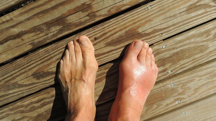 Foto hanya ILUSTRASI - Pembengkakan pada kaki