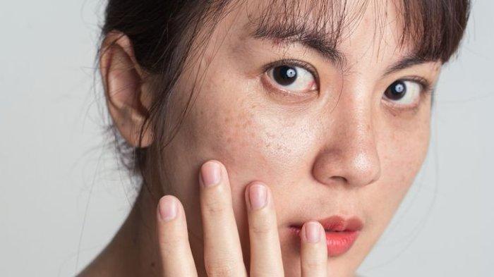 ilustrasi freckless atau flek pada kulit