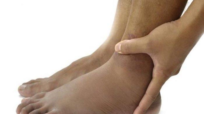 ilustrasi pasien yang mengalami pembengkakan kaki, tanda-tanda diabetes