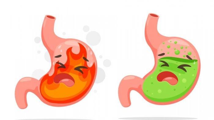 ilustrasi penyakit gerd/asam lambung