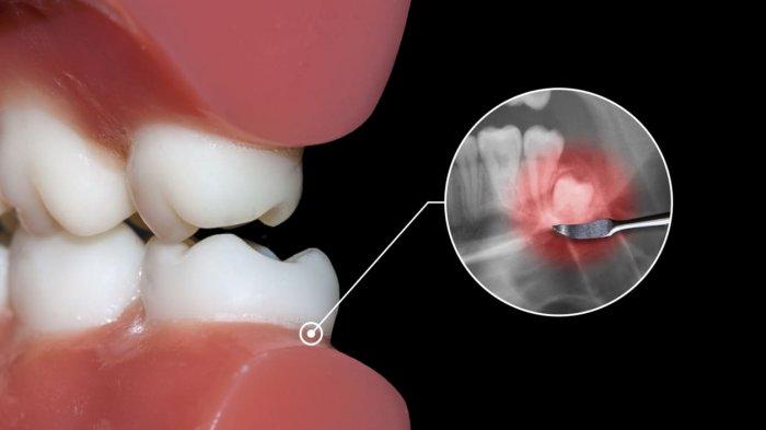 ilustrasi gigi bungsu