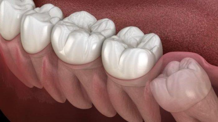 ilustrasi gigi bungsu yang bermasalah