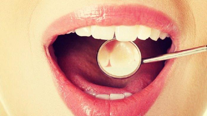 ilustrasi gingivitis