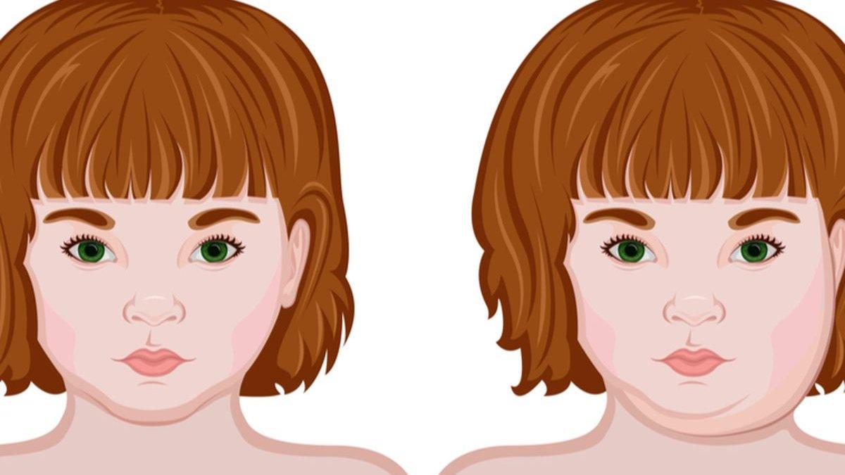 ilustrasi gondongan yang terjadi pada anak-anak