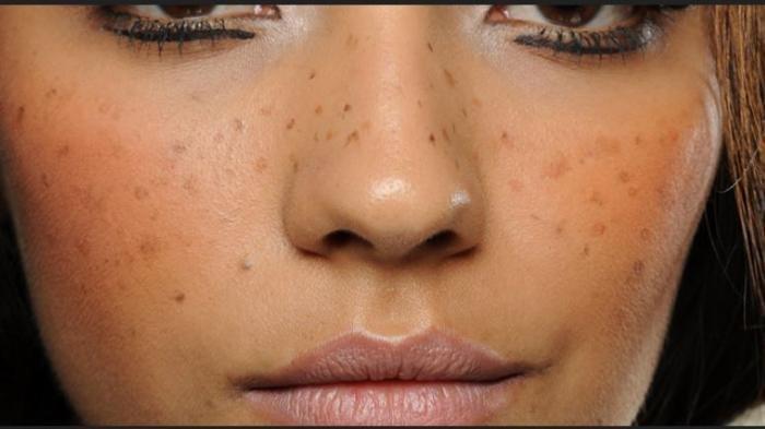 Ilustrasi adanya melasma atau flek hitam