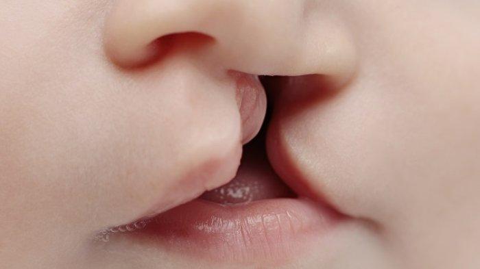 Ilustrasi anak bibir sumbing, begini ulasan