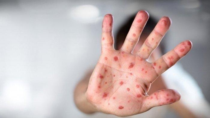 Ilustrasi anak terinfeksi flu Singapura
