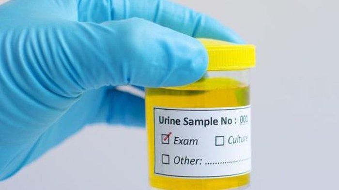 Ilustrasi analisis urine