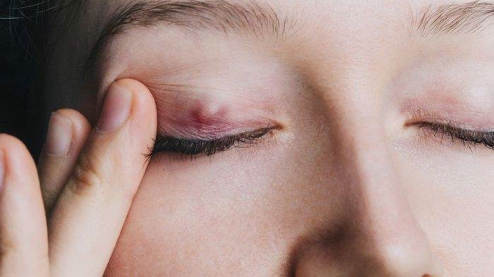 Ilustrasi benjolan pada kelopak mata 