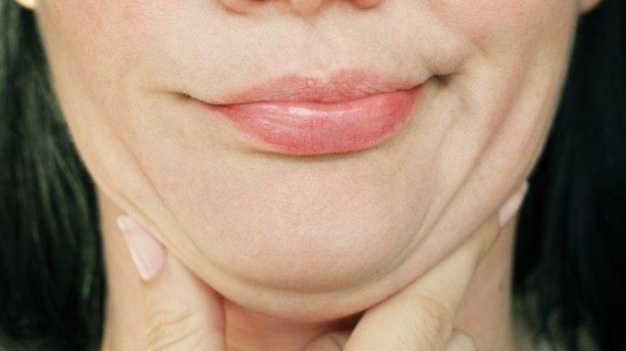 Ilustrasi double chin akibat obesitas