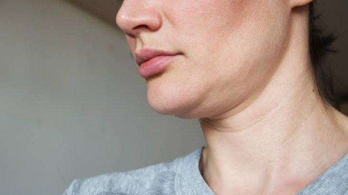 Ilustrasi double chin yang bisa diatasi dengan perawatan kecantikan