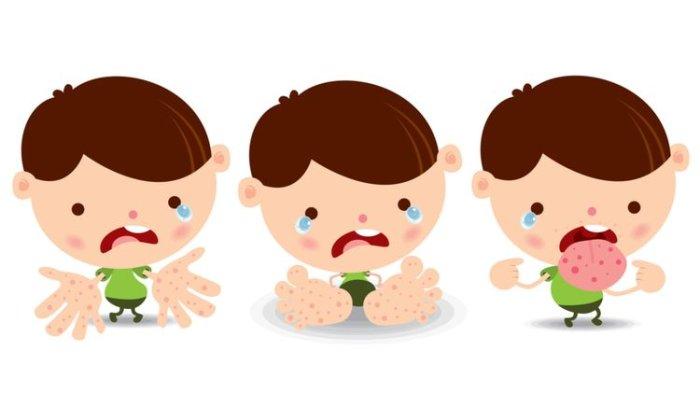 Ilustrasi flu Singapura