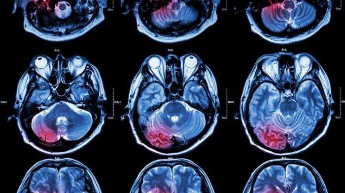 Ilustrasi hasil MRI otak