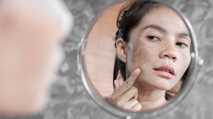 Ilustrasi seseorang yang mengalami hiperpigmentasi, berikut treatment untuk mengatasinya