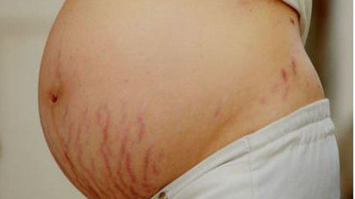 Ilustrasi munculnya stretch mark saat kehamilan, berikut penjelasan Dokter Kulit