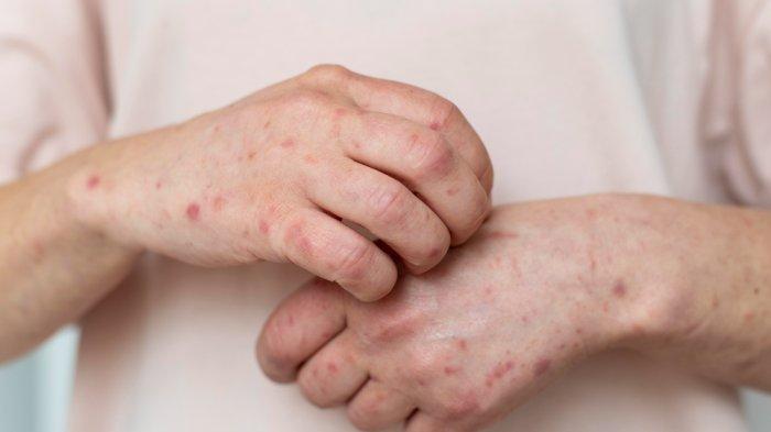 ILUSTRASI - Kasus monkeypox atau cacar monyet