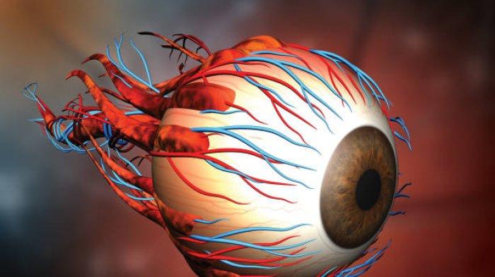 Ilustrasi komplikasi terberat pengguna softlens
