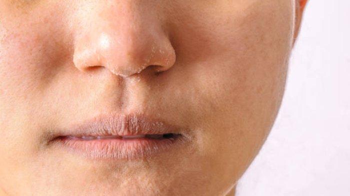 Ilustrasi kulit mengelupas akibat penggunaan skincare abal-abal