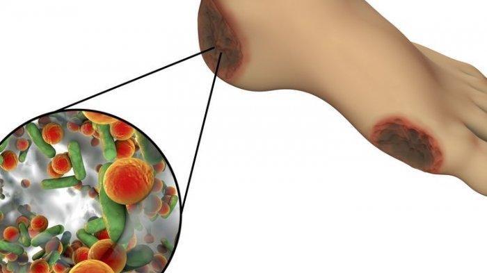 Ilustrasi luka diabetes pada telapak kaki