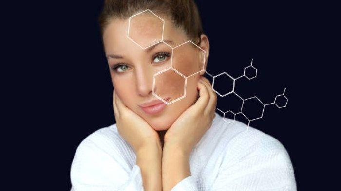 Ilustrasi melasma di area wajah
