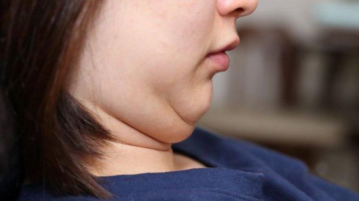 Ilustrasi memiliki double chin
