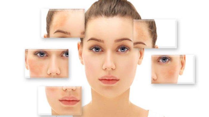 Ilustrasi mencegah melasma muncul kembali]
