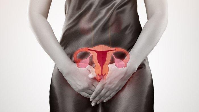 Ilustrasi mioma uteri