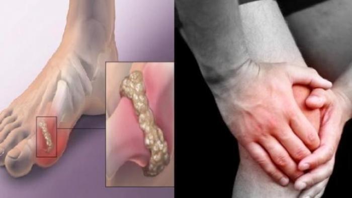 Ilustrasi nyeri akibat kadar asam urat tinggi