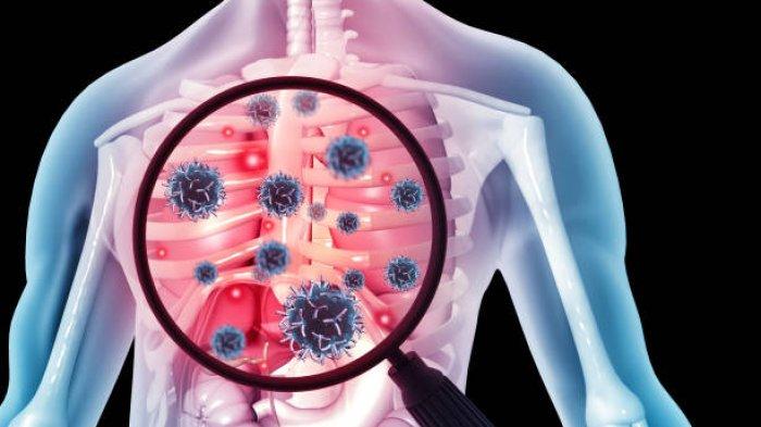 Ilustrasi pasien tuberkulosis (TBC), begini penuturan