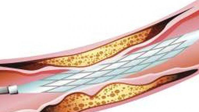 Ilustrasi pembuluh darah, menjaga sistem pembuluh darah adalah upaya untuk mencegah terjadinya stroke